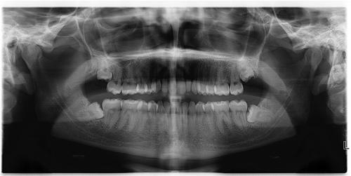 X-ray of impacted wisdom teeth