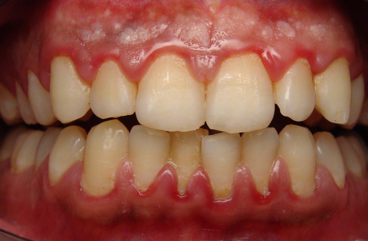 swollen gums after dentist visit