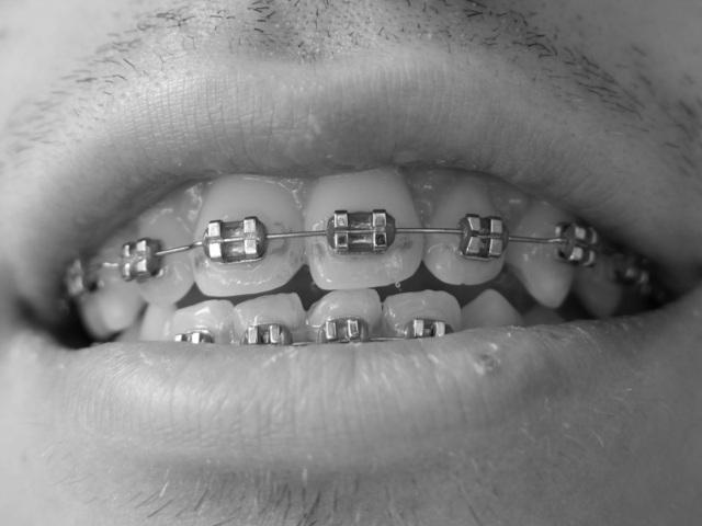 Smiling Metal Braces
