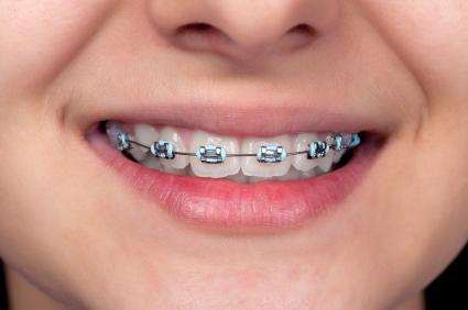 Sminling Child with Braces