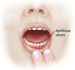 A small, shallow sore inside the mouth.