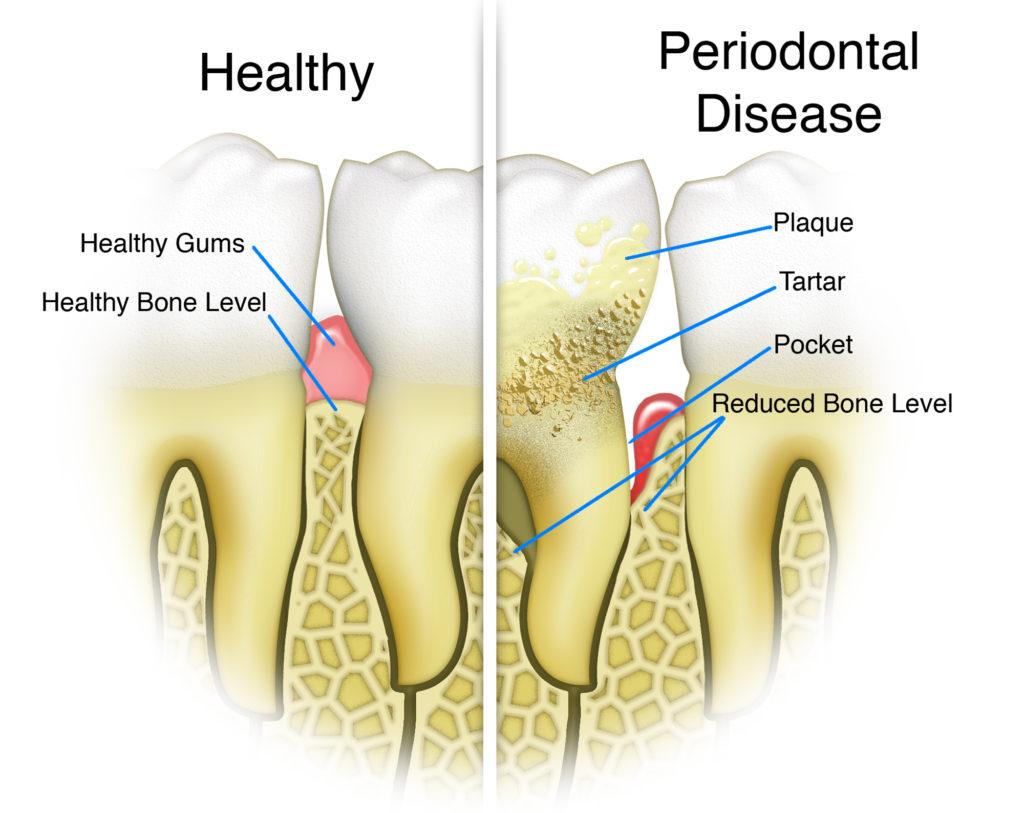 Periodontal Disease and Healthy teeth
