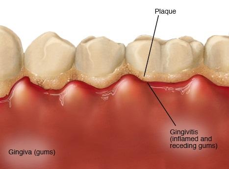 Gingivitis - Symptoms and causes