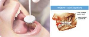 Important part of teeth called wisdom teeth