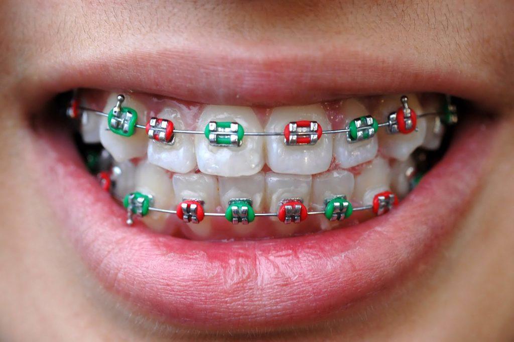 Braces