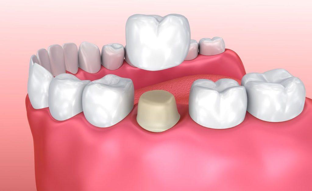 Illustration of Dental Crown