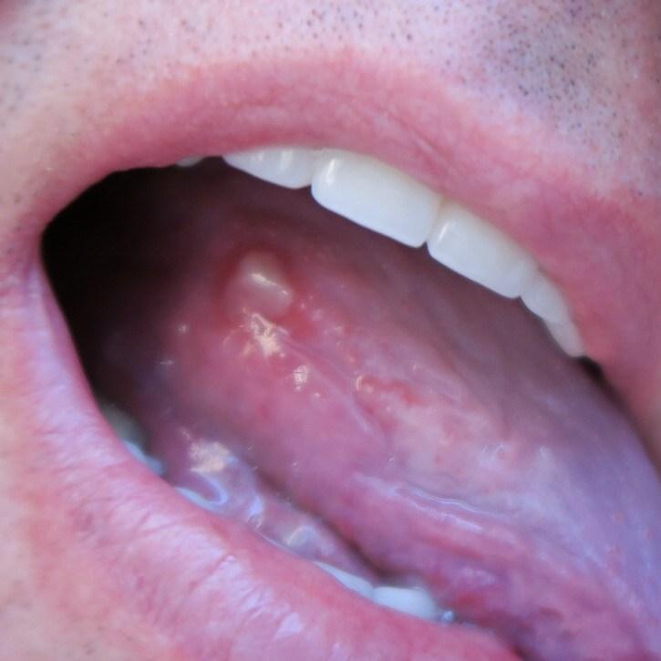 oral mucositis | My Cancer Journey