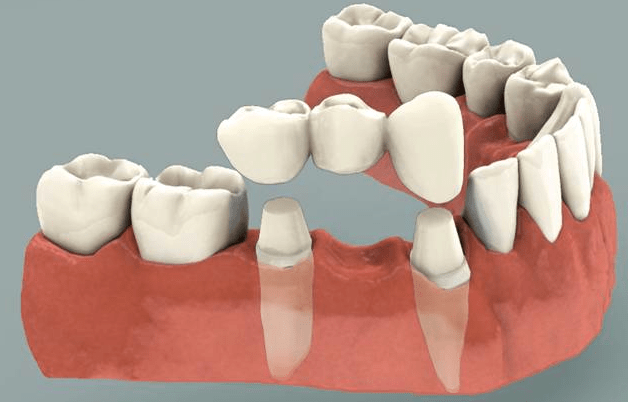 Affordable Same Day Dental Bridges