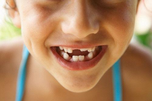 Missing Adult Teeth in Children