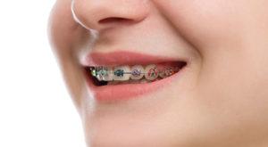 How Much Do Ceramic Braces Cost in 2019