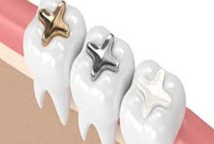 METAL-FREE-FILLINGS