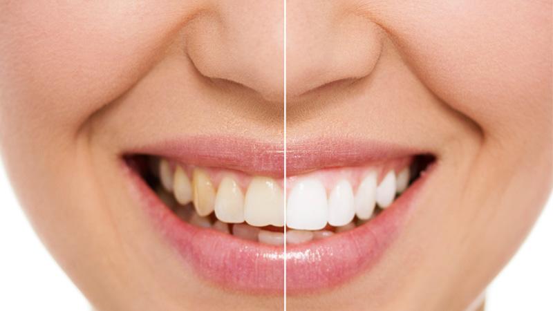 Teeth Whitening Before and After Orem Dentist