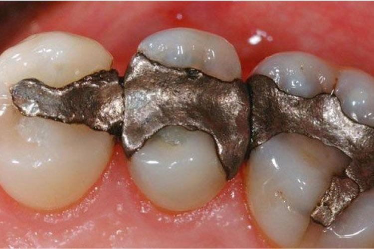Amalgam (Silver-Colored Dental Fillings)