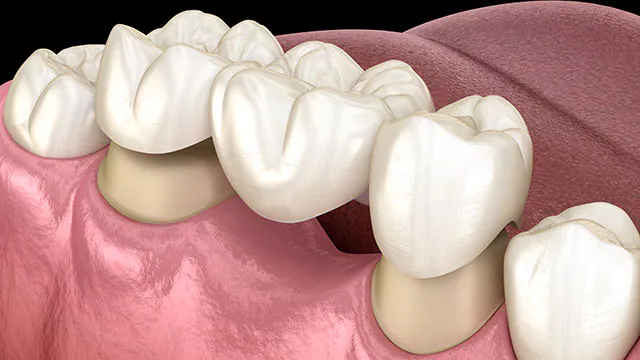 Dental Bridges in Orem Utah