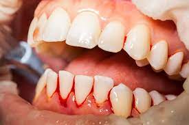 Orem Bleeding Gums