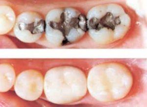 Tooth Colored Fillings