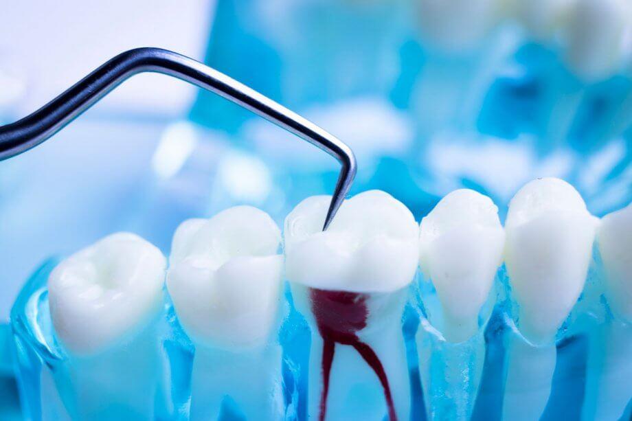 How Root Canal Can Save Your Tooth