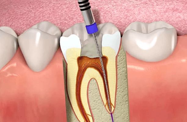 What Happens During a Root Canal Procedure