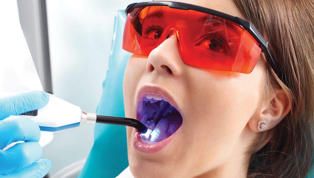 Sealants to Prevent Cavities