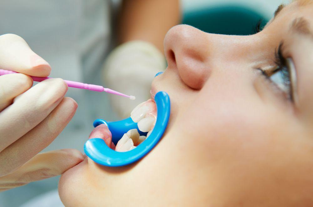 Sealants to Prevent Cavities