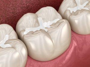 Sealants to Prevent Cavities