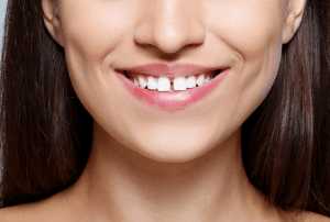 DIASTEMA