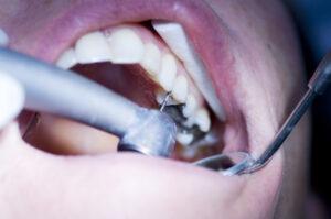 The Replacement of Metal Fillings and Crowns
