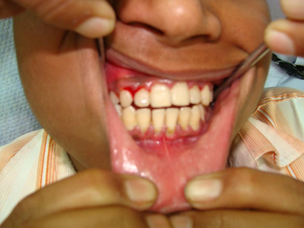 Gum Disease in Orem Utah