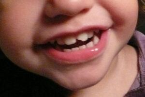 Child with broken tooth
