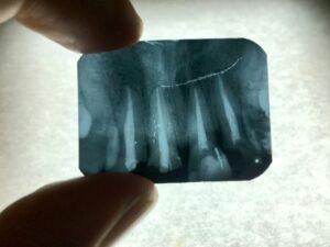 Pain Of Tooth Decay On Teeth X-Ray