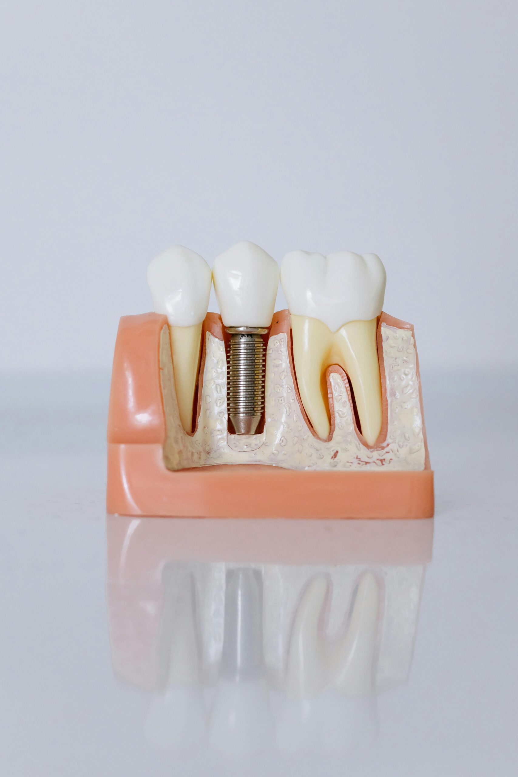 Implant Restorations 1 Closeup of dental implant model