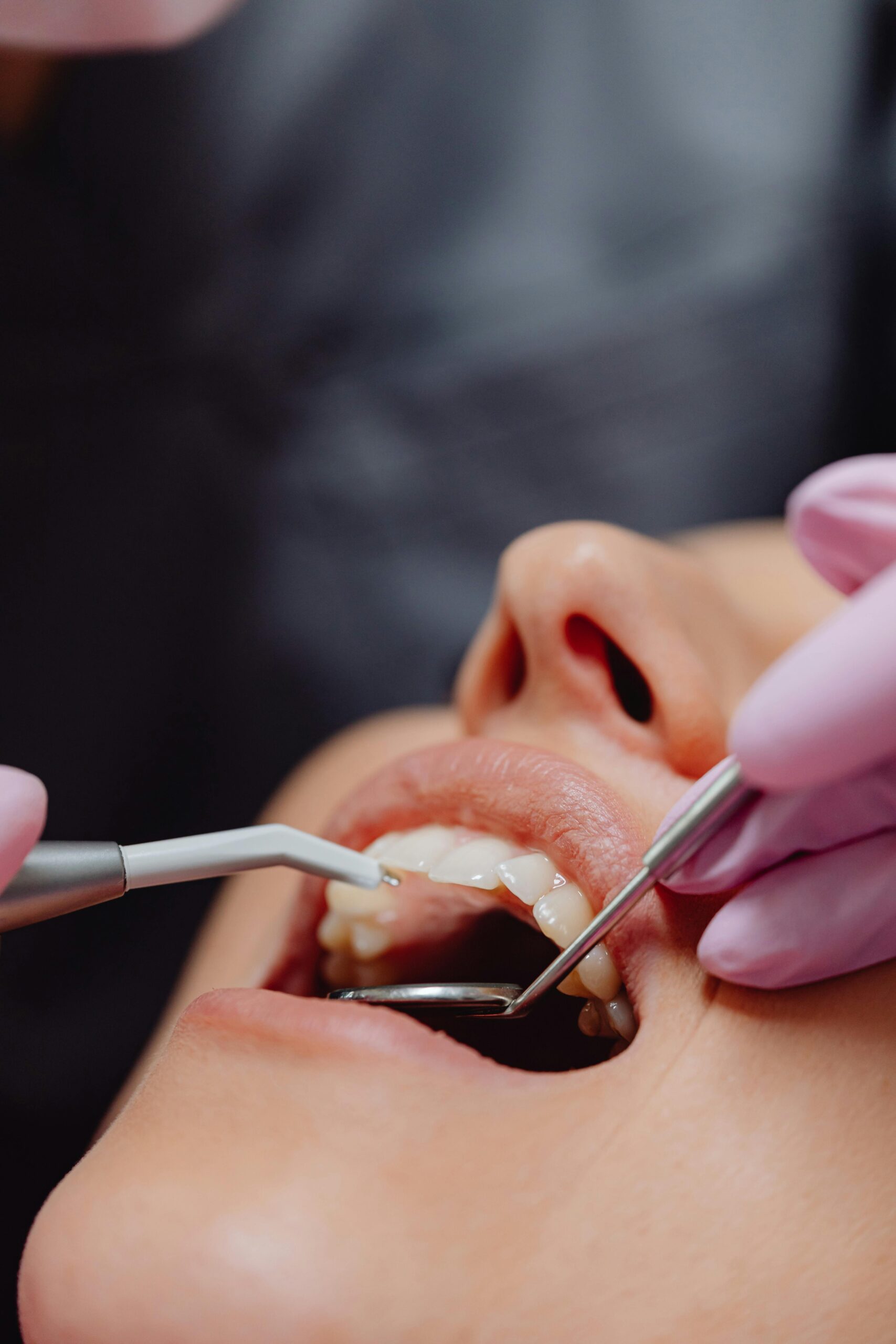 Fluoride 1 Dental Checkup and Floride Treatment