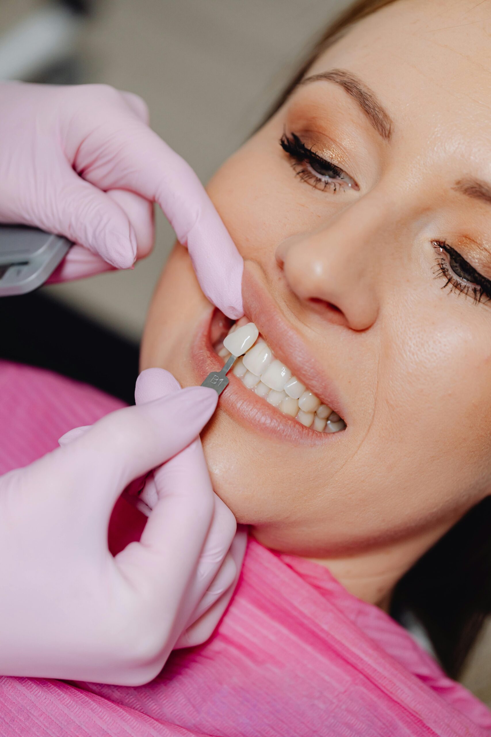 Veneers 2 Dentist Applying Dental Veneer