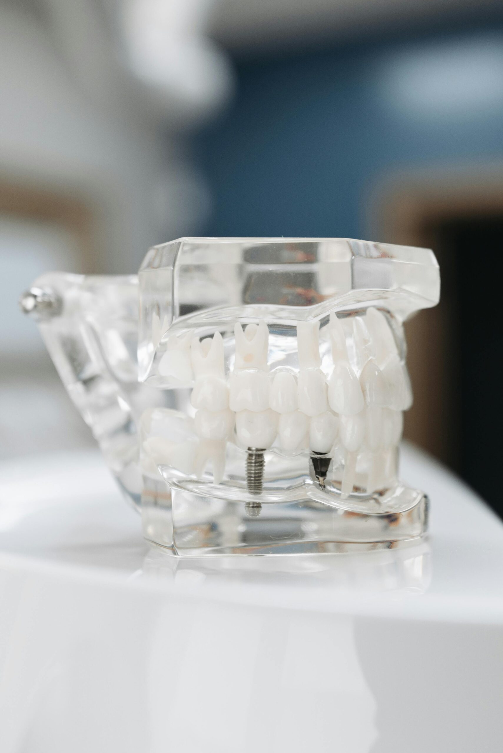 Implant Restorations 2 Dental Implant Model