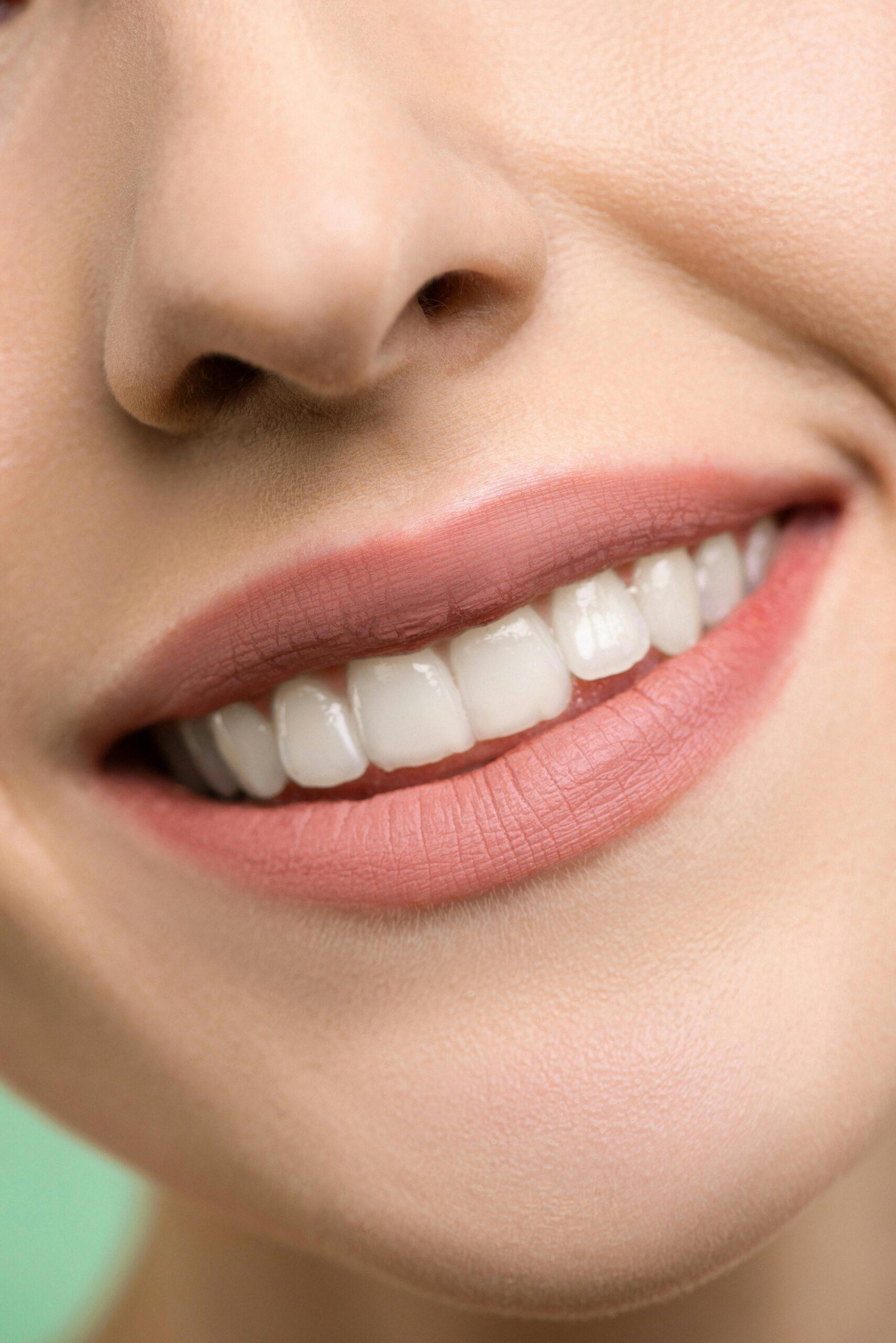 Teeth Whitening 1 Beautiful smile