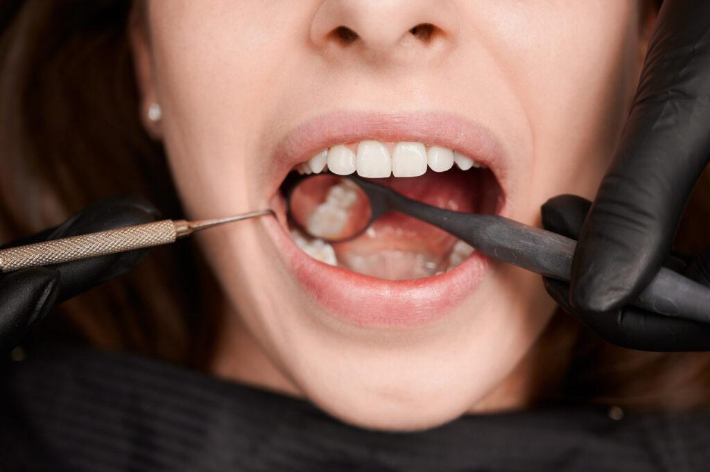 Why More Orem Patients Are Choosing Metal-Free Fillings for a Healthier, Natural-Looking Smile 1 Close-up of a dental professional examining a patient's teeth with dental instruments during a check-up for cavities or fillings, focusing on healthy white teeth.