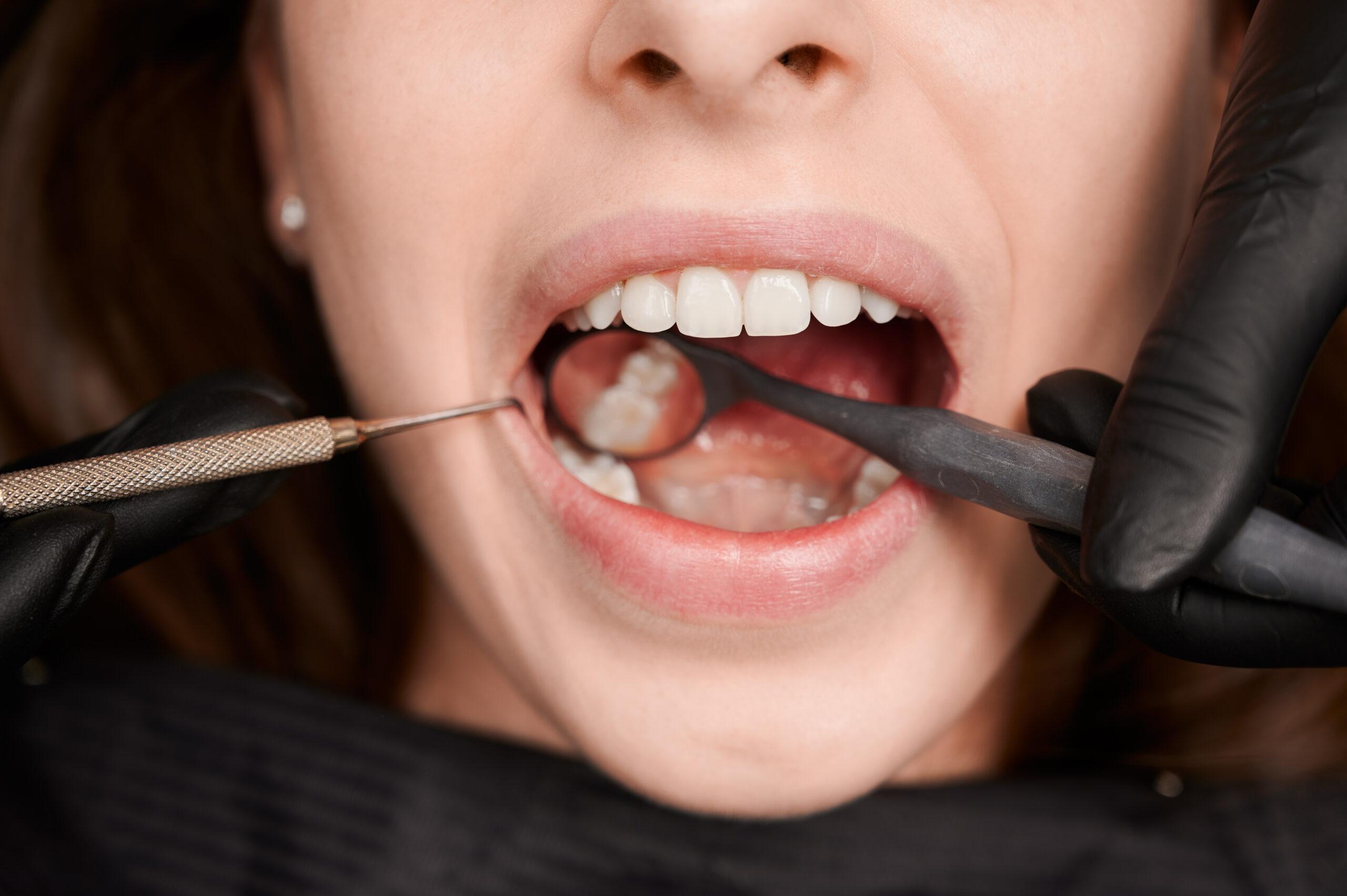 Close-up of a dental professional examining a patient's teeth with dental instruments during a check-up for cavities or fillings, focusing on healthy white teeth.