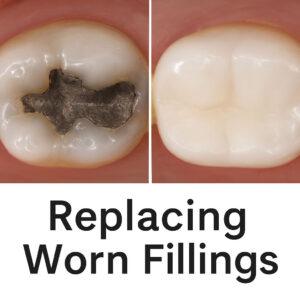 Side-by-side close-up image showing an old silver filling on one tooth and a new tooth-colored composite filling on another